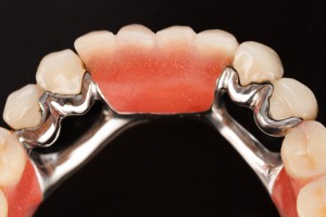 Partial Denture